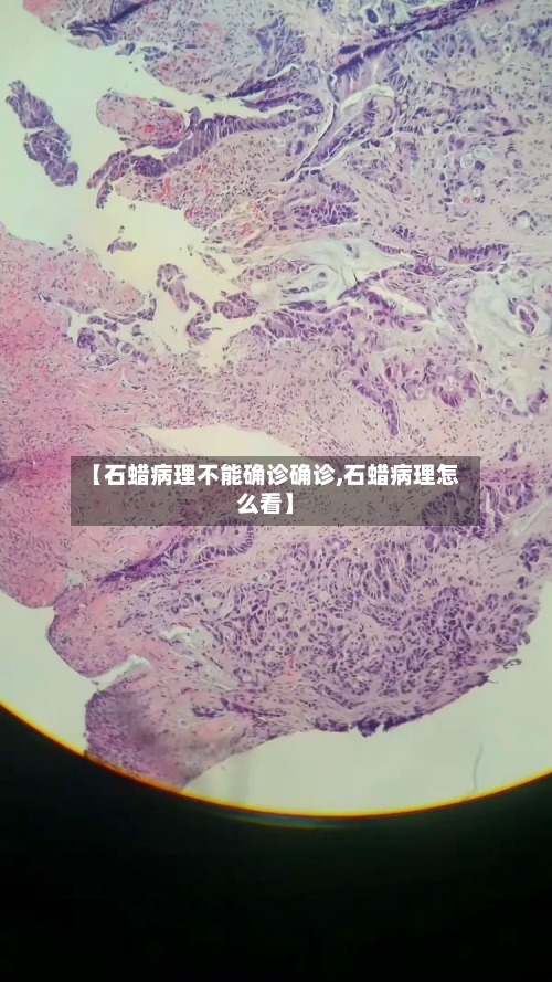 【石蜡病理不能确诊确诊,石蜡病理怎么看】-第2张图片