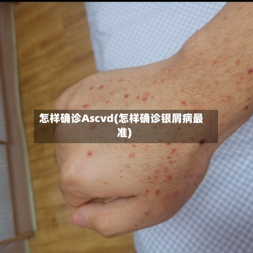 怎样确诊Ascvd(怎样确诊银屑病最准)