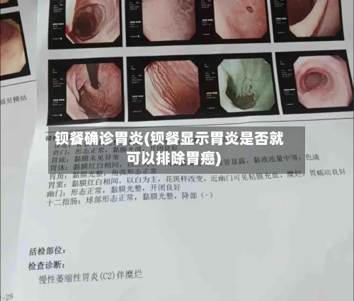 钡餐确诊胃炎(钡餐显示胃炎是否就可以排除胃癌)