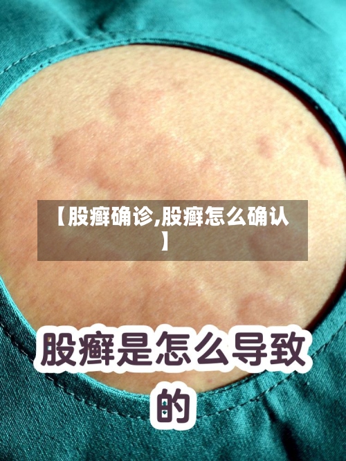 【股癣确诊,股癣怎么确认】-第2张图片