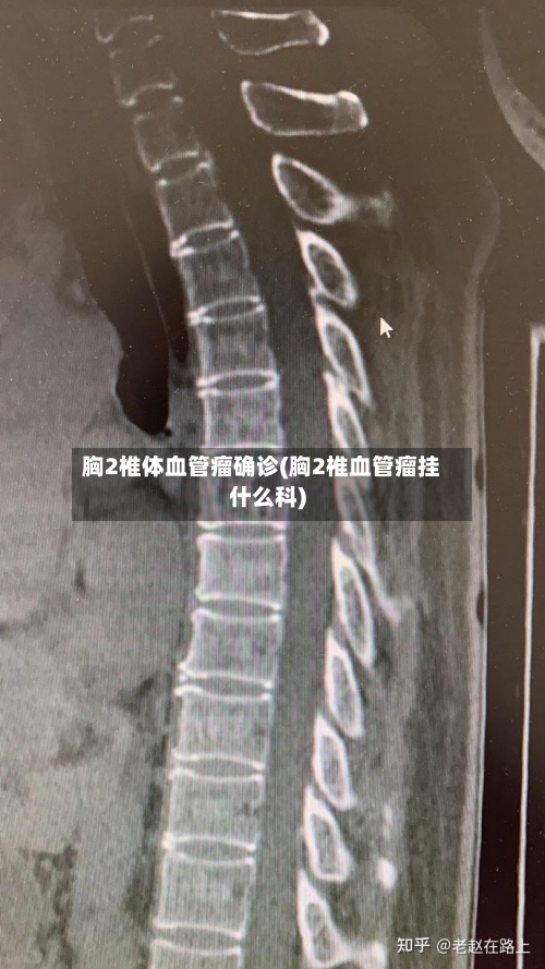 胸2椎体血管瘤确诊(胸2椎血管瘤挂什么科)-第3张图片