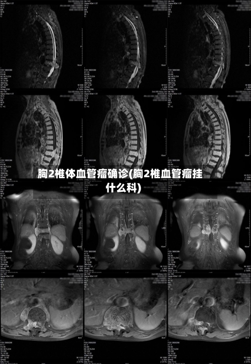 胸2椎体血管瘤确诊(胸2椎血管瘤挂什么科)-第2张图片