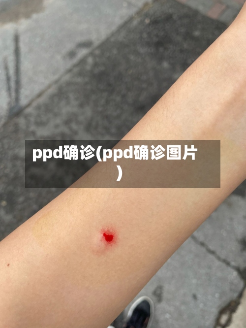 ppd确诊(ppd确诊图片)