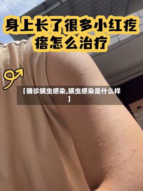 【确诊螨虫感染,螨虫感染是什么样】